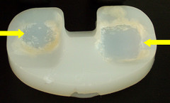 Severely worn polyethylene tibial bearing