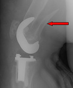 X-ray od fracture that necessitates a revision knee replacement