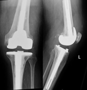 X-ray of revision knee replacement after surgery
