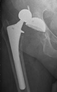 X-ray of dislocated hip replacement