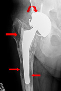 X-ray showing mechanical loosening of hip prosthesis