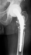 X-ray of hip with temporary cement hip spacer in place