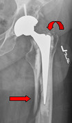 X-ray of hip fracture after hip replacement