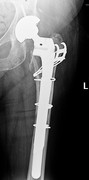 X-ray of complex hip revision