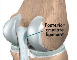 Posterior cruciate ligament injuries - Orthopedic Surgeon For Hip, Knee ...