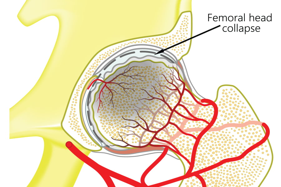 Avascular necrosis of the hip | Naples' best orthopaedic surgeon