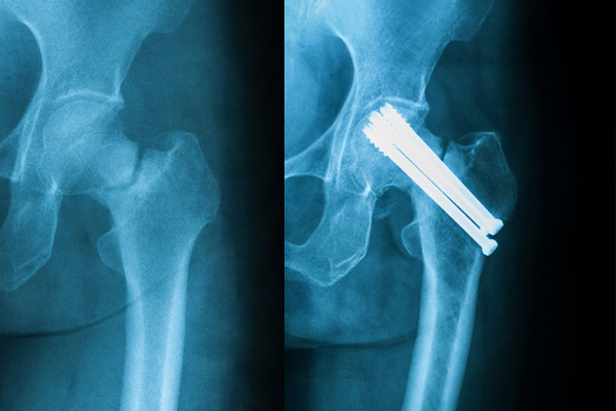 Can a hairline hip fracture heal on its own?