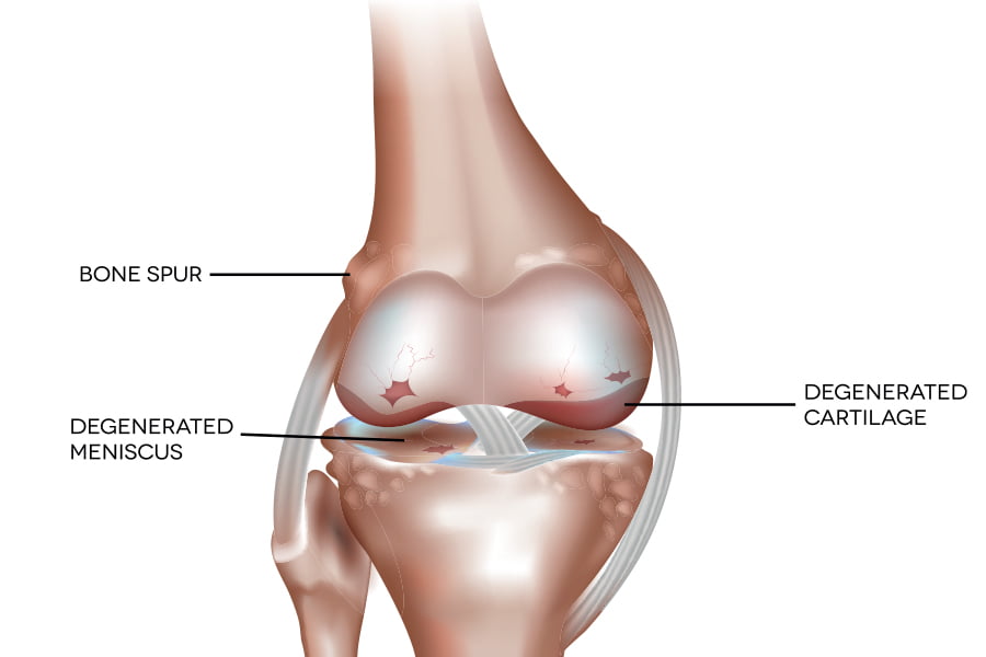 Knee shop cartilage pain