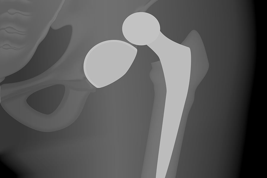 Hip dislocation following surgery avoid hip dislocation