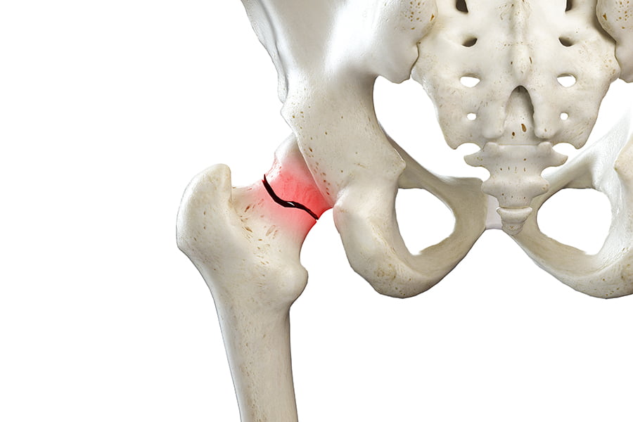 Should you repair a fractured hip or replace a fractured hip