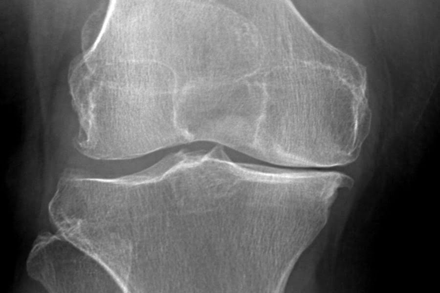 An Xray does not signal the need for knee replacement