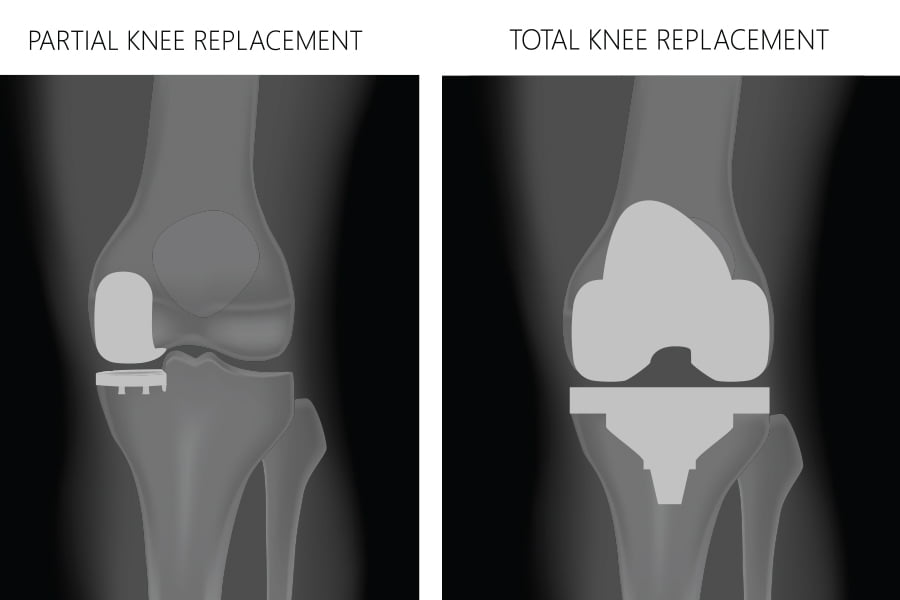 Total Vs. Partial Joint Replacement Surgery